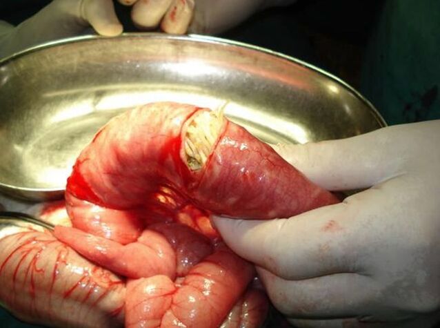 vermes no intestino humano